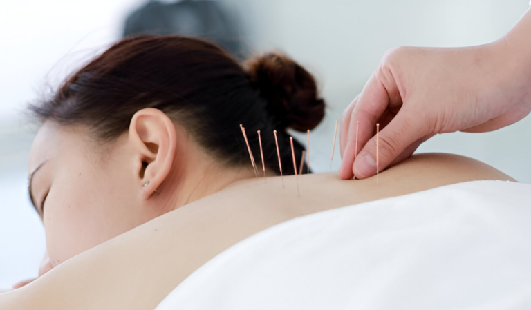 Acupuncture